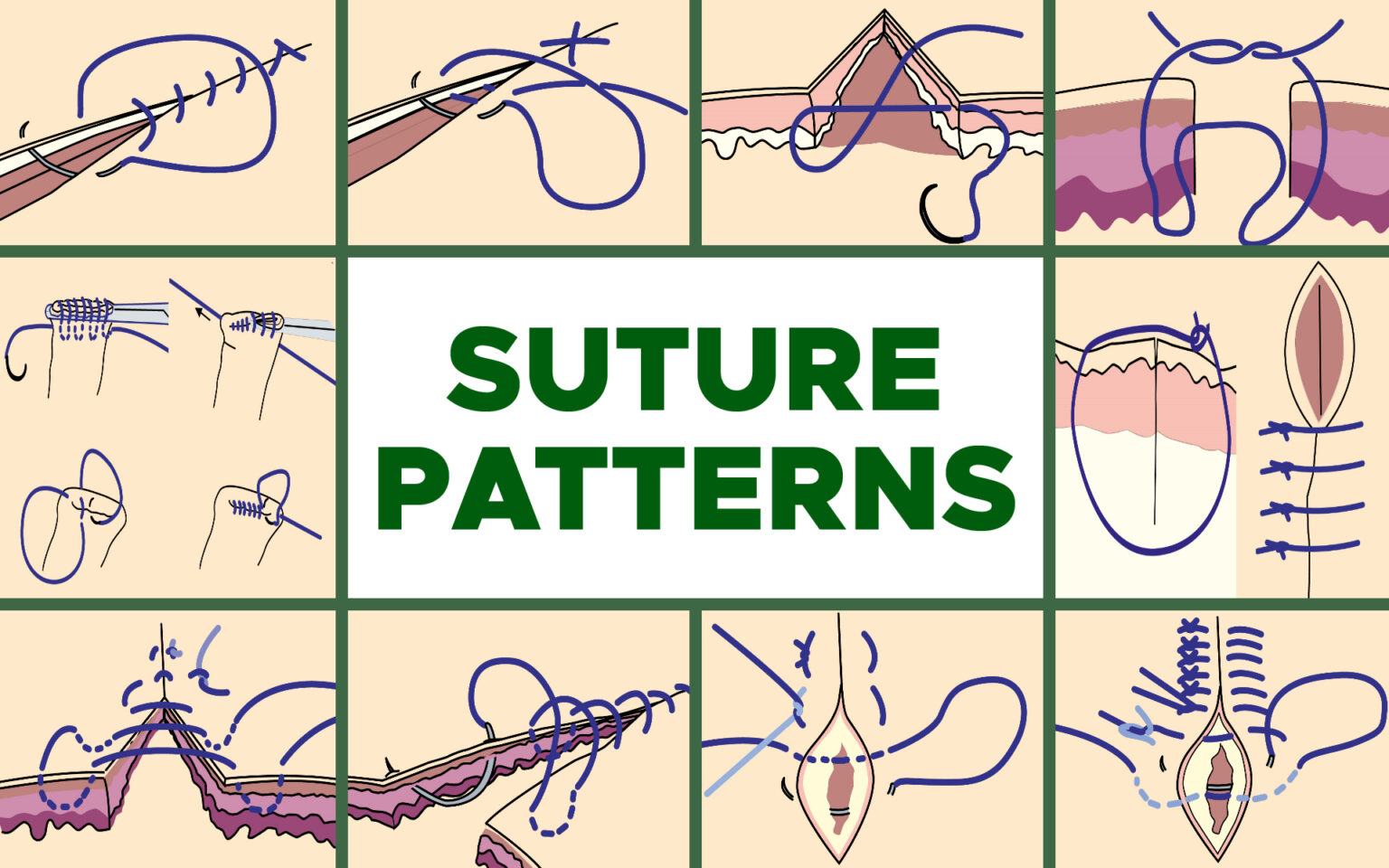 The Strangest Suture Techniques: A Guide for Medical Students in Jordan